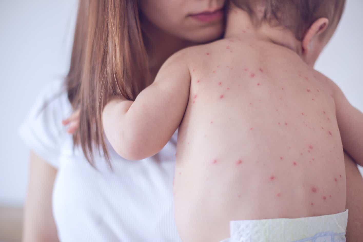sarampo: a doença que ataca o corpo por dentro e por fora
