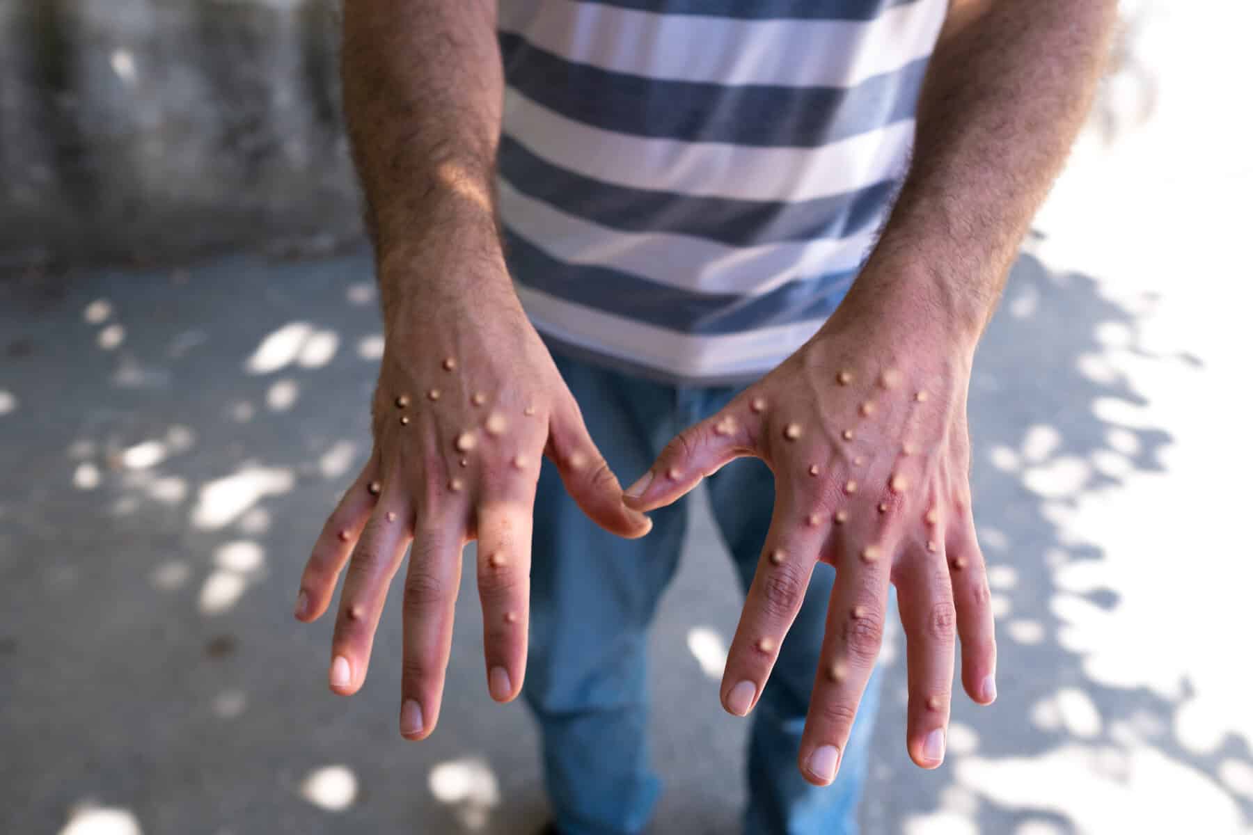 Monkeypox nos Açores
